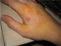 RFID implant in hand